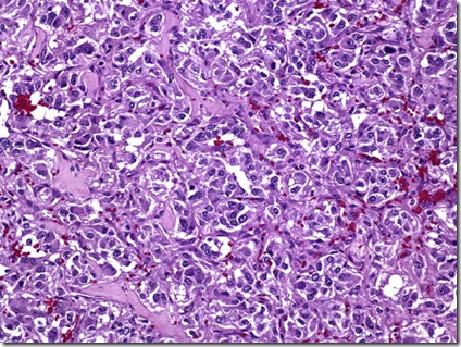 Adrenal Disorders – Pheochromocytoma | Medatrio